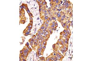 Immunohistochemistry (Paraffin-embedded Sections) (IHC (p)) image for anti-Matrix Metallopeptidase 14 (Membrane-inserted) (MMP14) (AA 145-174), (N-Term) antibody (ABIN390138)