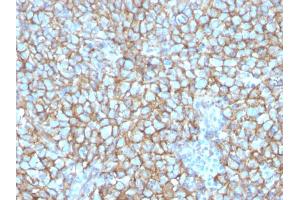 Formalin-fixed, paraffin-embedded human Melanoma stained with MCAM Mouse Monoclonal Antibody (MCAM/3048). (MCAM 抗体  (AA 226-374))