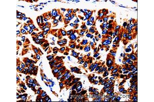 Immunohistochemistry of Human lung cancer using UTS2 Polyclonal Antibody at dilution of 1:50 (Urotensin 2 抗体)