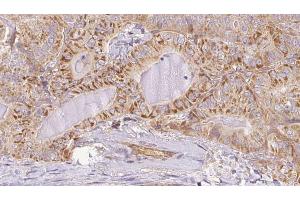 ABIN6267094 at 1/100 staining Human thyroid cancer tissue by IHC-P. (ATG14 抗体  (pSer29))