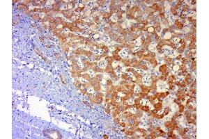 Paraformaldehyde-fixed, paraffin embedded human lung carcinoma, Antigen retrieval by boiling in sodium citrate buffer (pH6) for 15min, Block endogenous peroxidase by 3% hydrogen peroxide for 30 minutes, Blocking buffer (normal goat serum) at 37°C for 20min, Antibody incubation with 	JNK1 + 3 Polyclonal Antibody, Unconjugated  at 1:500 overnight at 4°C, followed by a conjugated secondary and DAB staining. (JNK 抗体  (AA 201-300))
