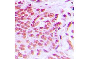 Immunohistochemical analysis of NAB2 staining in human breast cancer formalin fixed paraffin embedded tissue section. (NAB2 抗体  (Center))