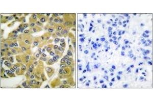 Immunohistochemistry analysis of paraffin-embedded human breast carcinoma, using IKK-beta (Phospho-Tyr188) Antibody. (IKBKB 抗体  (pTyr188))