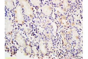 Formalin-fixed and paraffin embedded human gastric carcinoma tissue labeled with Anti-PAF Polyclonal Antibody, Unconjugated at 1:200 followed by conjugation to the secondary antibody and DAB staining (KIAA0101 抗体)