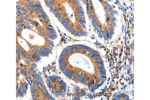 Immunohistochemistry of Human ovarian cancer using IGFBP7 Polyclonal Antibody at dilution of 1:50 (IGFBP7 抗体)