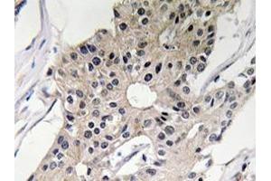 Immunohistochemistry analyzes of Defensin alpha-1 antibody in paraffin-embedded human breast carcinoma tissue. (alpha Defensin 1 抗体)