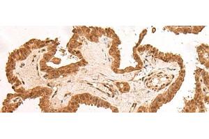Immunohistochemistry of paraffin-embedded Human thyroid cancer tissue using ARMC8 Polyclonal Antibody at dilution of 1:40(x200) (ARMC8 抗体)