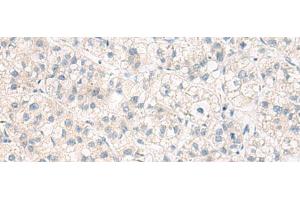 Immunohistochemistry of paraffin-embedded Human liver cancer tissue using ANKS6 Polyclonal Antibody at dilution of 1:55(x200) (ANKS6 抗体)