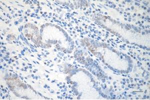 Immunohistochemistry was performed on paraffin-embedded human gastric carcinoma using DDB2 antibody (ABIN7798274), 1:200). (Recombinant DDB2 抗体)