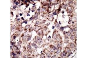 IHC analysis of FFPE human breast carcinoma tissue stained with the RAGE antibody (RAGE 抗体  (AA 29-59))