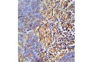 Immunohistochemistry analysis in formalin fixed and paraffin embedded human lung carcinoma reacted with HLA-DRB5 Antibody (Center) followed which was peroxidase conjugated to the secondary antibody and followed by DAB staining. (HLA-DRB5 抗体  (Middle Region))