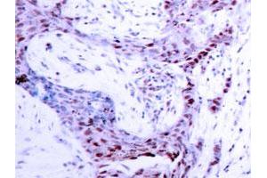 Immunohistochemistry analysis of paraffin-embedded human breast carcinoma tissue with PRNP (phospho S190) polyclonal antibody . (PRNP 抗体  (pSer190))