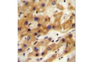 Immunohistochemistry analysis in formalin fixed and paraffin embedded human hepatocarcinoma reacted with GAGE13 Antibody (N-term) followed by peroxidase conjugation of the secondary antibody and DAB staining. (G Antigen 13 抗体  (N-Term))
