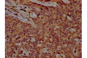 IHC image of ABIN7152402 diluted at 1:500 and staining in paraffin-embedded human liver cancer performed on a Leica BondTM system. (Cyclin F 抗体  (AA 248-400))