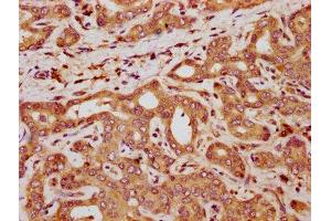 IHC image of ABIN7161592 diluted at 1:300 and staining in paraffin-embedded human liver cancer performed on a Leica BondTM system. (QPRT 抗体  (AA 113-254))