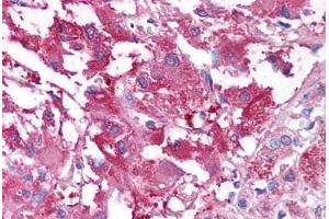 Human Adrenal Medulla (formalin-fixed, paraffin-embedded) stained with USP20 antibody ABIN213605 at 10 ug/ml followed by biotinylated goat anti-rabbit IgG secondary antibody ABIN481713, alkaline phosphatase-streptavidin and chromogen. (USP20 抗体  (Internal Region))