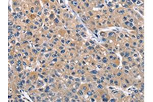 The image on the left is immunohistochemistry of paraffin-embedded Human liver cancer tissue using ABIN7128963(CLEC2D Antibody) at dilution 1/70, on the right is treated with fusion protein. (CLEC2D 抗体)