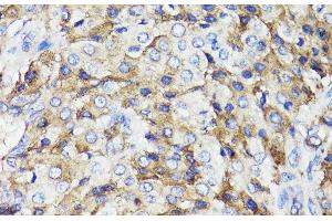 Immunohistochemistry of paraffin-embedded Human lung cancer using CD59 Polyclonal Antibody at dilution of 1:100 (40x lens). (CD59 抗体)