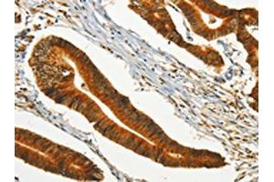 The image on the left is immunohistochemistry of paraffin-embedded Human colon cancer tissue using ABIN7190246(CHRDL2 Antibody) at dilution 1/20, on the right is treated with synthetic peptide. (CHRDL2 抗体)