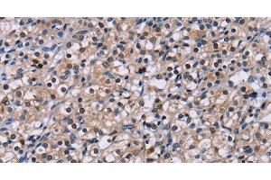 Immunohistochemistry of paraffin-embedded Human prostate cancer tissue using NR1D1 Polyclonal Antibody at dilution 1:60 (NR1D1 抗体)