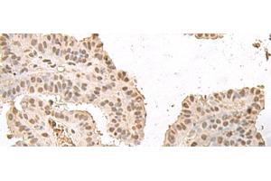 Immunohistochemistry of paraffin-embedded Human thyroid cancer tissue using HMGN2 Polyclonal Antibody at dilution of 1:35(x200) (HMGN2 抗体)