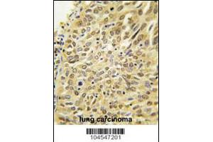 Formalin-fixed and paraffin-embedded human lung carcinoma tissue reacted with Dsk2 Antibody , which was peroxidase-conjugated to the secondary antibody, followed by DAB staining.