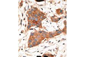 Formalin-fixed and paraffin-embedded human cancer tissue reacted with the primary antibody, which was peroxidase-conjugated to the secondary antibody, followed by DAB staining. (GJA3 抗体  (N-Term))
