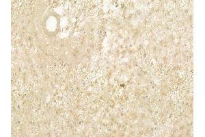 ABIN6260825 and ABIN6277501 at 1/100 staining human astrocytoma by IHC-P. (CHRNB1 抗体  (N-Term))