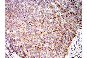 Immunohistochemical analysis of paraffin-embedded bladder cancer tissues using C3C mouse mAb with DAB staining. (Complement C3c 抗体  (AA 1521-1649))