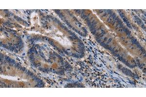 Immunohistochemistry of paraffin-embedded Human colon cancer tissue using ITPR2 Polyclonal Antibody at dilution 1:40 (ITPR2 抗体)