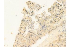 ABIN6258807 and ABIN6273863 at 1/100 staining human hepatocellular carcinoma by IHC-P. (GPR25 抗体  (Internal Region))