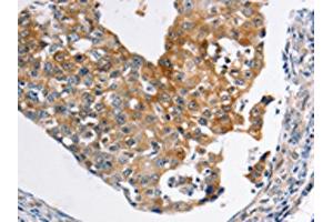 The image on the left is immunohistochemistry of paraffin-embedded Human breast cancer tissue using ABIN7189590(ABCC3 Antibody) at dilution 1/20, on the right is treated with synthetic peptide. (ABCC3 抗体)
