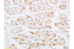 Formalin-fixed and paraffin embedded human colon carcinoma labeled with Anti Phospho-MAP3K8/Tpl2 (Thr290) Polyclonal Antibody, Unconjugated (ABIN746588) at 1:200 followed by conjugation to the secondary antibody and DAB staining (MAP3K8 抗体  (pThr290))
