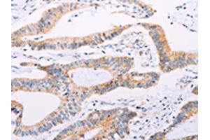 The image on the left is immunohistochemistry of paraffin-embedded Human colon cancer tissue using ABIN7189654(ADAMTS16 Antibody) at dilution 1/50, on the right is treated with synthetic peptide. (ADAMTS16 抗体)