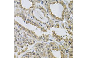 Immunohistochemistry of paraffin-embedded human thyroid cancer using NCF4 Antibody (ABIN1873838) at dilution of 1:100 (40x lens). (NCF4 抗体)
