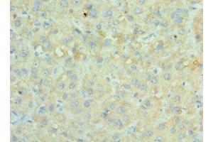 Immunohistochemistry of paraffin-embedded human liver cancer using ABIN7170676 at dilution of 1:100 (SRPK1 抗体  (AA 290-480))