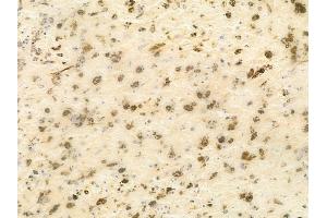 ABIN6256122 and ABIN6267379 at 1/100 staining human melanoma by IHC-P.