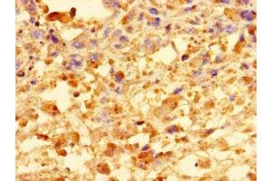 Immunohistochemistry of paraffin-embedded human melanoma using ABIN7148172 at dilution of 1:100 (CCDC91 抗体  (AA 1-180))
