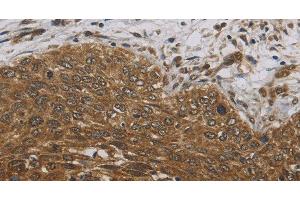 Immunohistochemistry of paraffin-embedded Human cervical cancer tissue using DCTN3 Polyclonal Antibody at dilution 1:70 (DCTN3 抗体)