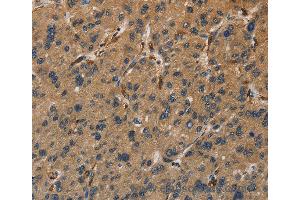 Immunohistochemistry of Human colon cancer using UBE2S Polyclonal Antibody at dilution of 1:40 (UBE2S 抗体)