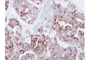 IHC-P Image Immunohistochemical analysis of paraffin-embedded human ovarian carainoma, using Fatty Acid Synthase, antibody at 1:500 dilution. (Fatty Acid Synthase 抗体  (N-Term))