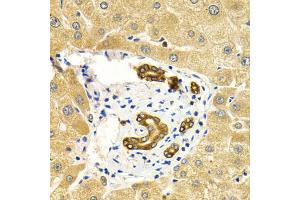 Immunohistochemistry of paraffin-embedded human liver injury using RAB27A Antibody (ABIN5970998) at dilution of 1/200 (40x lens). (RAB27A 抗体)