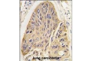 Forlin-fixed and paraffin-embedded hun lung carcino tissue reacted with hP2- antibody, which was peroxidase-conjugated to the secondary antibody, followed by DAB staining. (MAP2 抗体  (C-Term))