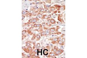 Formalin-fixed and paraffin-embedded human hepatocellular carcinoma tissue reacted with SRPK3 polyclonal antibody  , which was peroxidase-conjugated to the secondary antibody, followed by DAB staining. (SRPK3 抗体  (Internal Region))