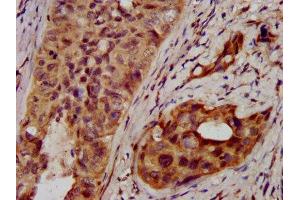 IHC image of ABIN7170786 diluted at 1:400 and staining in paraffin-embedded human cervical cancer performed on a Leica BondTM system. (NSDHL 抗体  (AA 154-211))