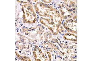 Immunohistochemistry of paraffin-embedded human kidney cancer using FZR1 antibody at dilution of 1:200 (40x lens). (FZR1 抗体)
