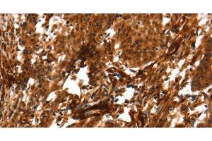 Immunohistochemistry of paraffin-embedded Human gastric cancer using ACTA2 Polyclonal Antibody at dilution of 1:40 (Smooth Muscle Actin 抗体)