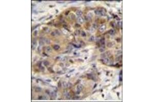Immunohistochemistry analysis in formalin fixed and paraffin embedded human breast carcinoma reacted with Glutathione reductase Antibody (C-term) followed by peroxidase conjugation of the secondary antibody and DAB staining. (Glutathione Reductase 抗体  (C-Term))
