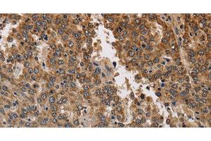 Immunohistochemistry of paraffin-embedded Human liver cancer using KCNK9 Polyclonal Antibody at dilution of 1:40 (KCNK9 抗体)