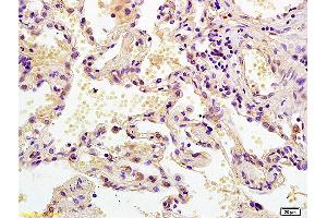 Formalin-fixed and paraffin embedded human lung carcinoma labeled with Anti MEK2/MAPKK2 Polyclonal Antibody, Unconjugated (ABIN726500) at 1:200 followed by conjugation to the secondary antibody and DAB staining.